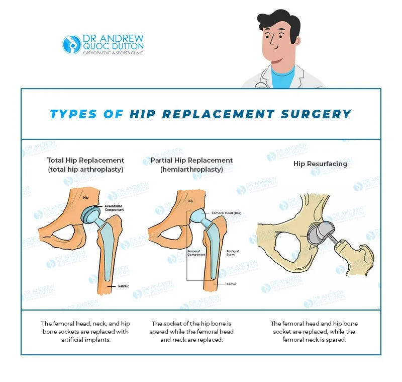 Types of hip replacement surgery | Dr Andrew Quoc Dutton